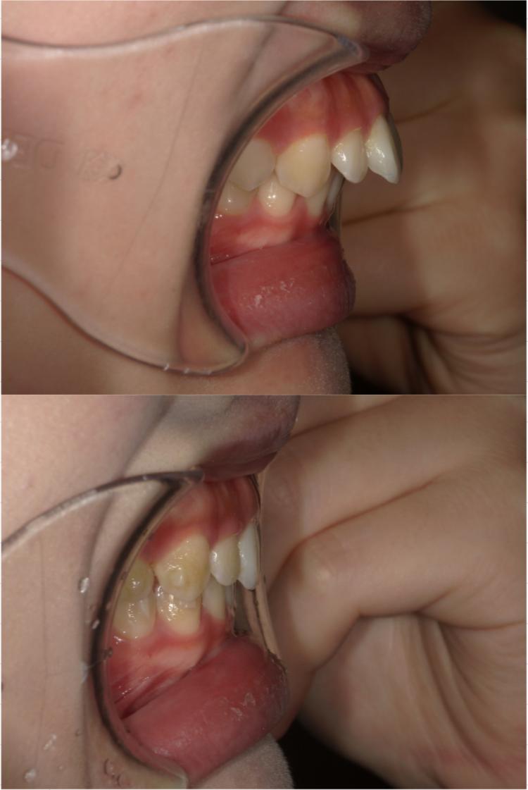 インビザライン・マウスピース矯正　11枚目