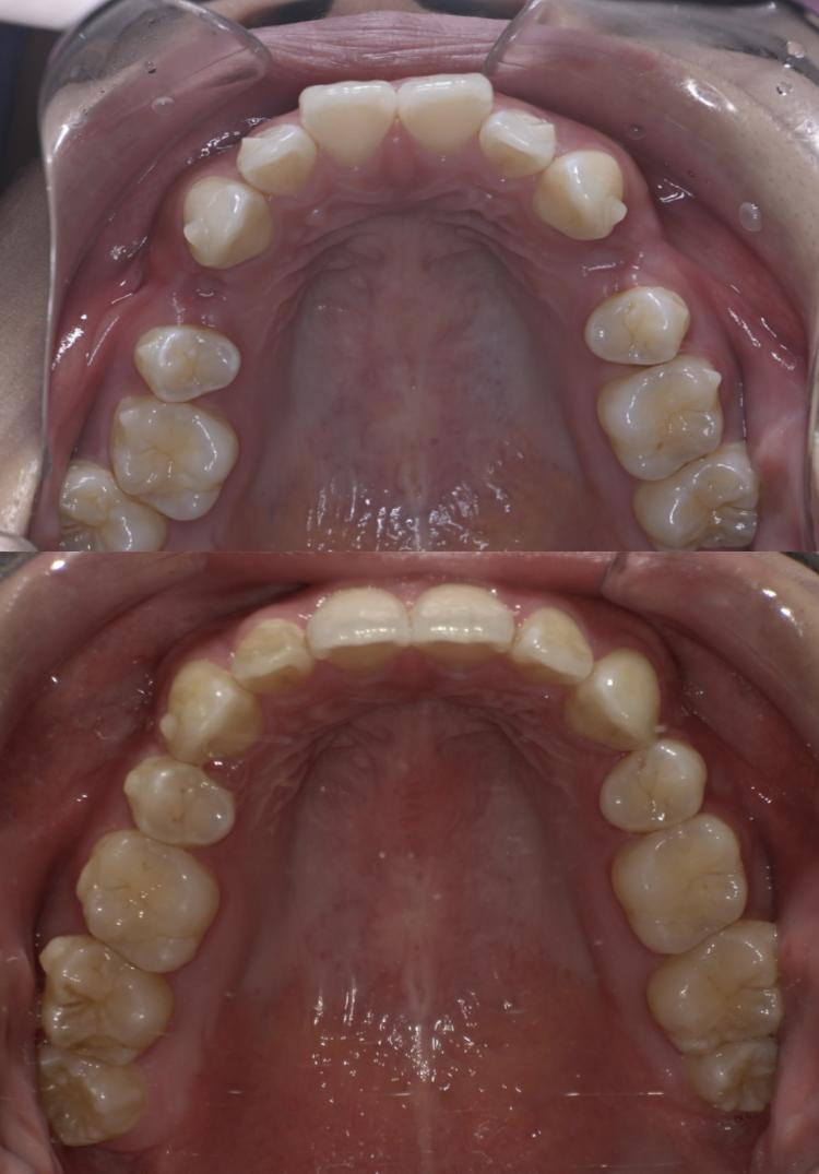 インビザライン・マウスピース矯正　14枚目