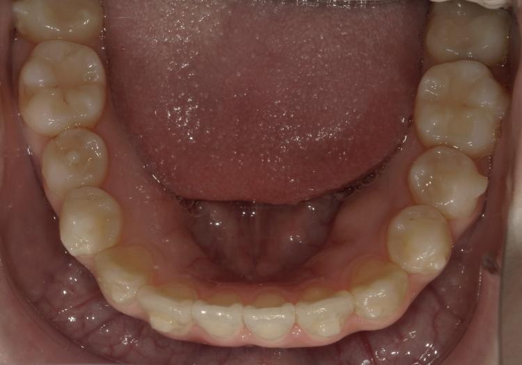 インビザライン・マウスピース矯正　23枚目