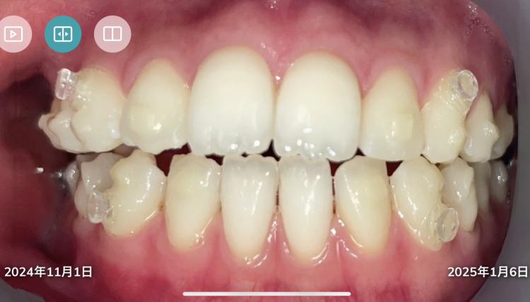 	インビザライン・マウスピース矯正　13枚目