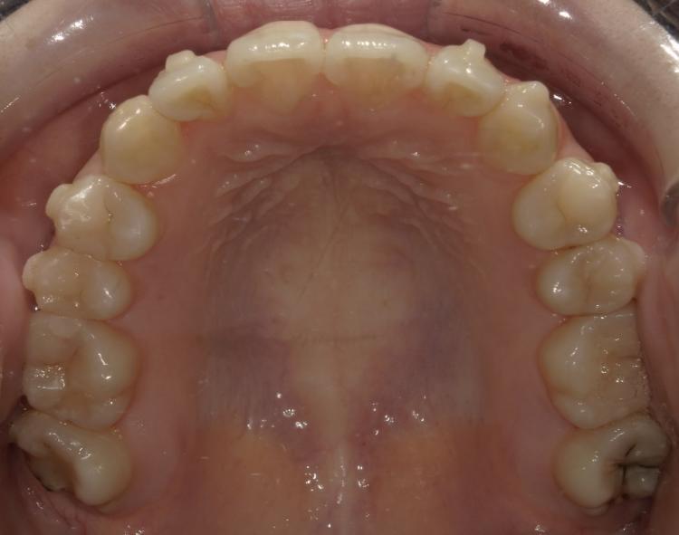 インビザライン・マウスピース矯正　22枚目