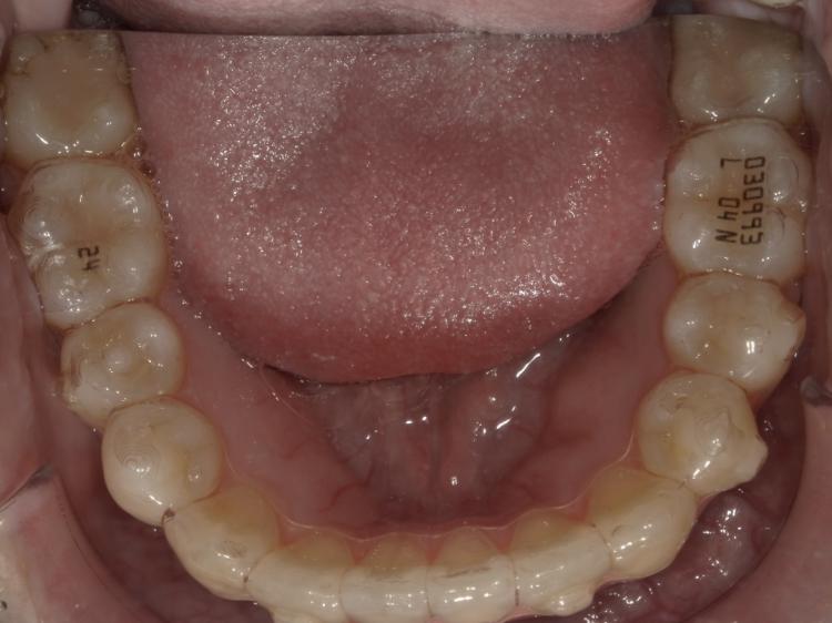 インビザライン・マウスピース矯正　5枚目