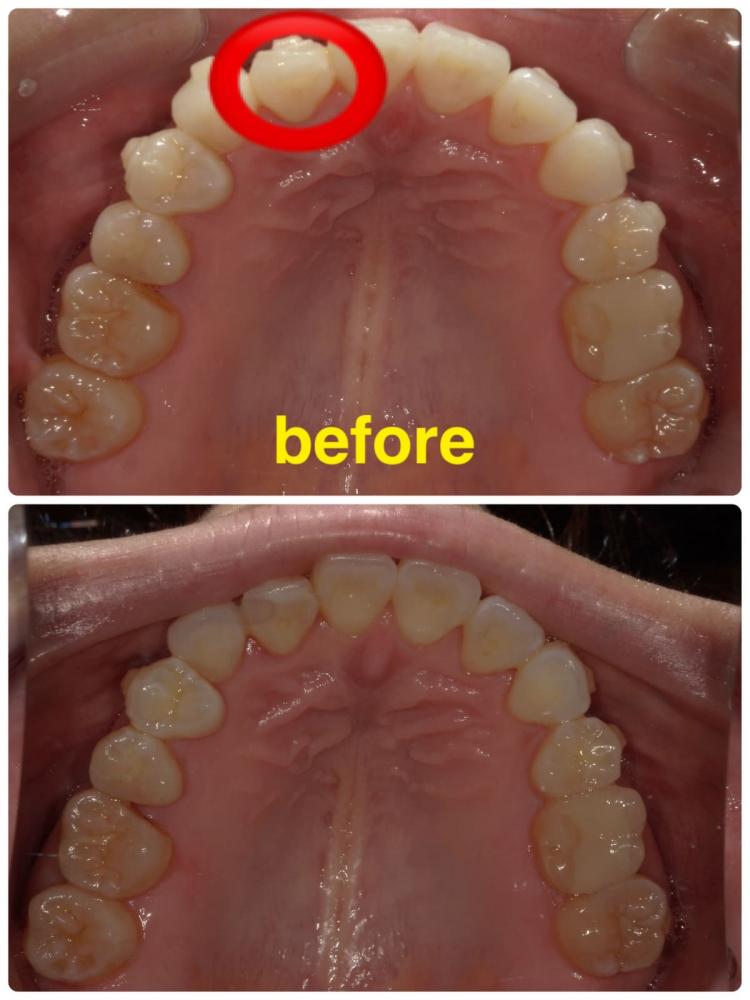 インビザライン・マウスピース矯正15枚目