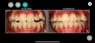 インビザライン・マウスピース矯正　2枚目