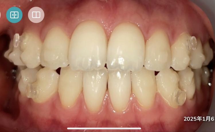 	インビザライン・マウスピース矯正　13枚目