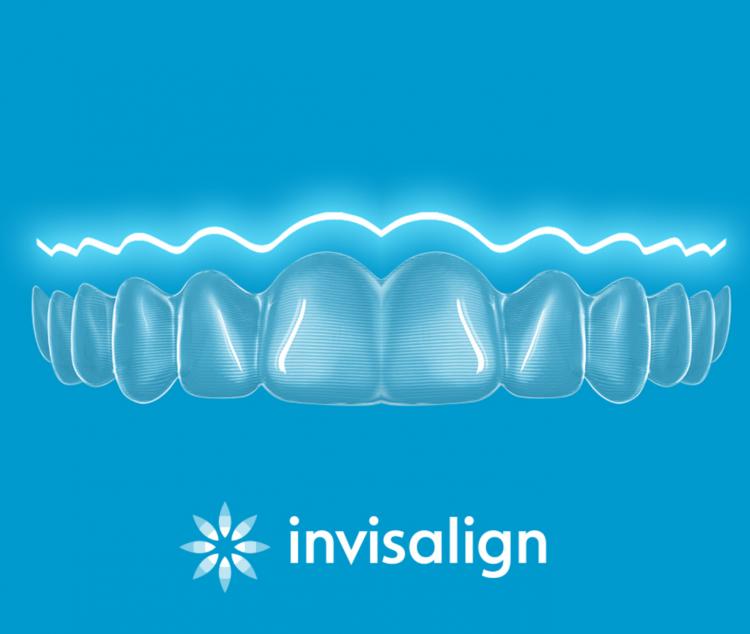 インビザライン・マウスピース矯正　