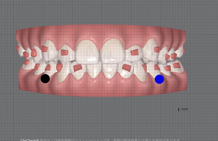 インビザライン・マウスピース矯正　5枚目