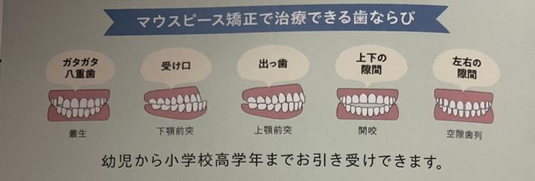 インビザライン・マウスピース矯正　8枚目