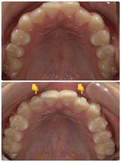 インビザライン・マウスピース矯正　5枚目